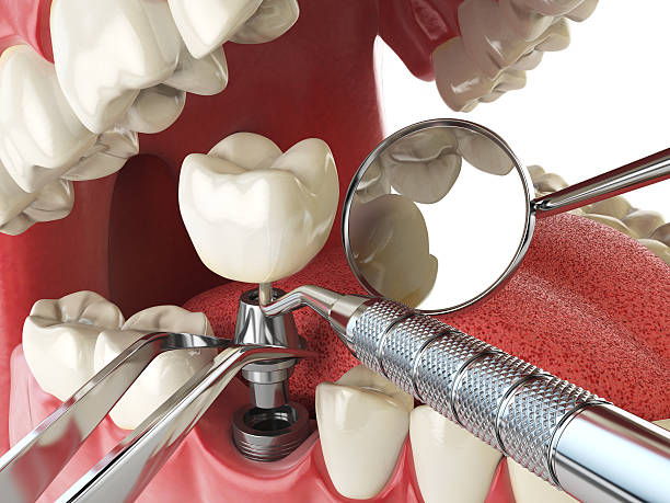 Best Emergency Dental Care for Broken or Chipped Teeth in Winnsboro Mills, SC